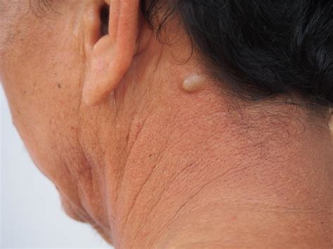 are sebaceous cysts cancerous.